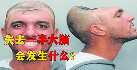 少了一半大脑会发生什么后果？