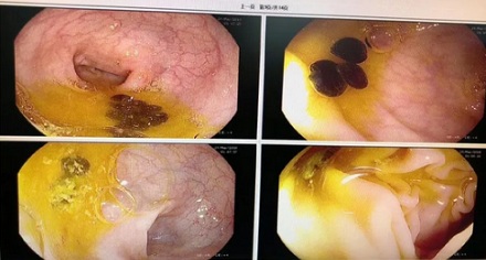 为什么做肠镜前千万不能吃香瓜？