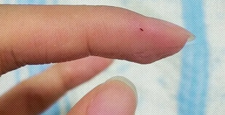 扎进皮肤里的各种刺，不管它们会怎么样？