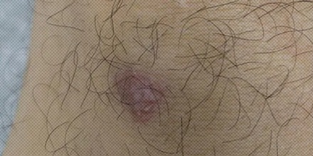 为什么伤口愈合后会长毛？那头皮受伤也能生发吗？