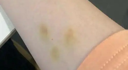 身上的淤青变成黄色，是快痊愈了还是更严重了？